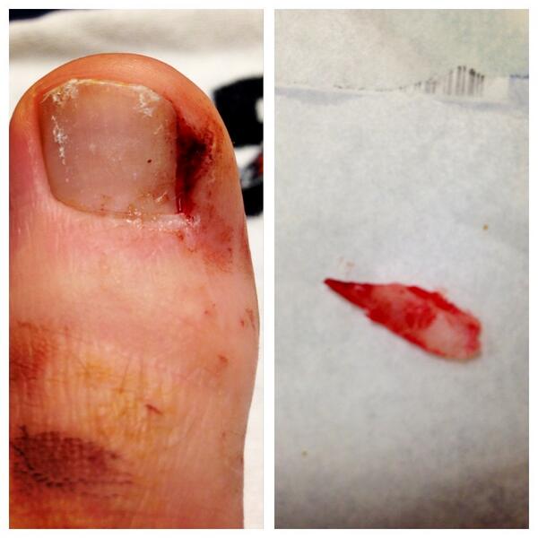 Bryce Harper tweets graphic photo following procedure for ingrown toenail